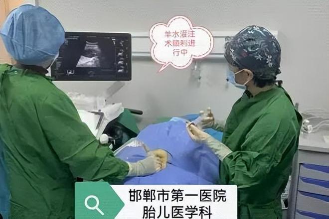 【邯鄲首例】邯鄲市第一醫(yī)院成功實施胎兒羊水灌注術(圖2)